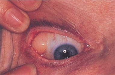 <p><span><span>•Dermoid - soft yellow limbal mass and Lipodermoid - soft white mass</span></span></p><ul><li><p><strong>normal tissue growing on the surface of the eye where it doesn’t belong</strong>.</p></li><li><p>monitor if vision isn’t affected</p></li><li><p>surgical excision: cosmesis, significant astigmatism, affects eyelid closure/ocular movement</p></li></ul><p></p>