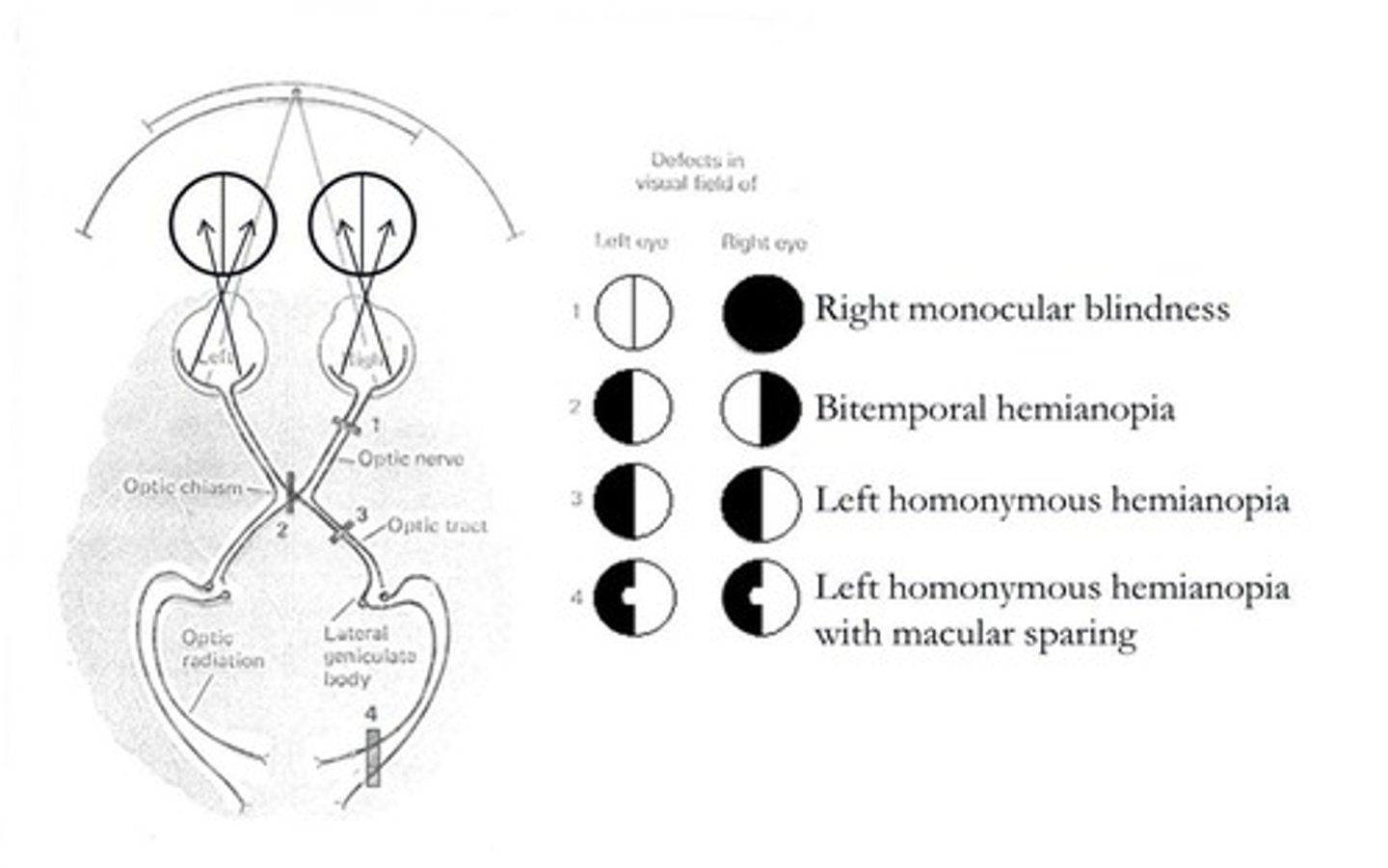 <p>Severed optic nerve in one eye.</p>