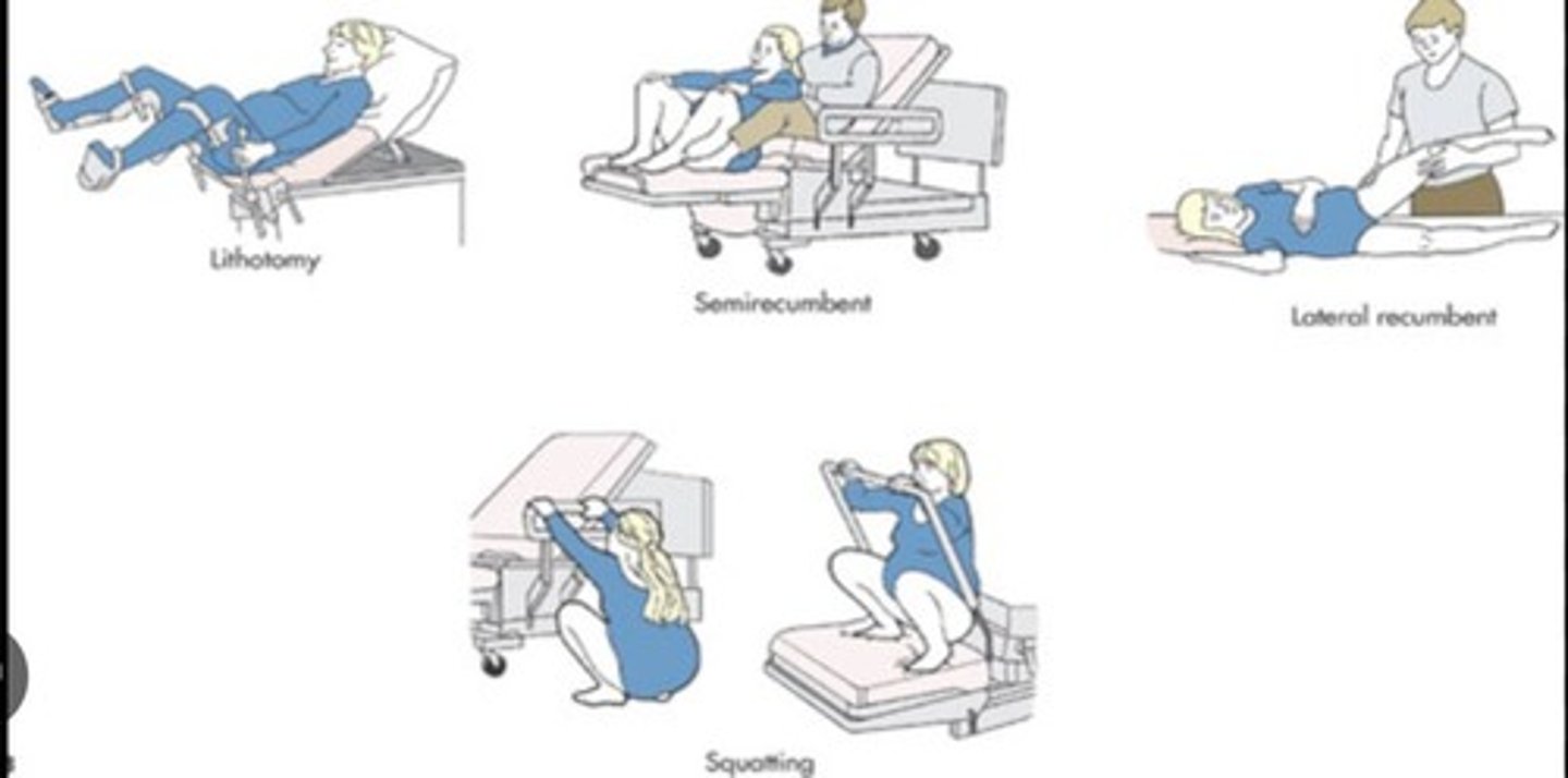 <p>A position where the mother is lying on her back with legs raised and supported, commonly used during childbirth.</p>