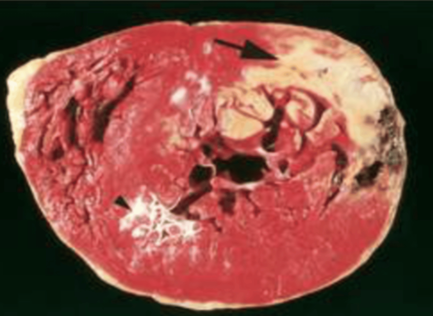 <p>myocardial infarction</p>