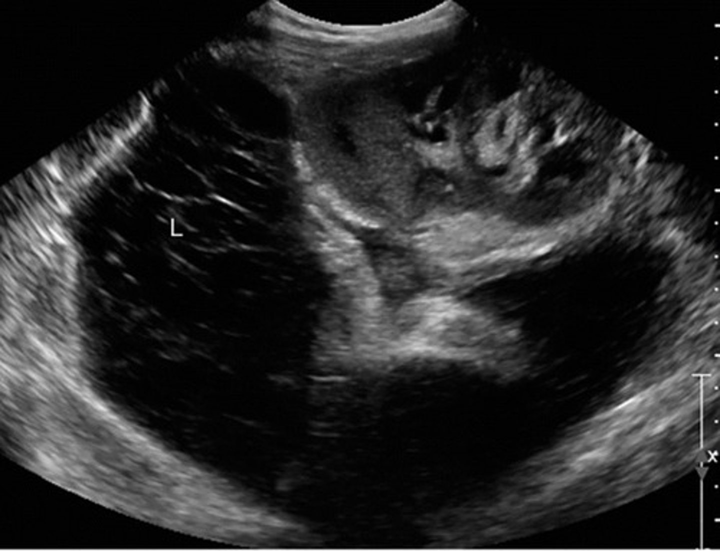 <p>Surgical nick in lymphatic system</p><p>Seen 4-8 weeks post-op</p><p>Complex appearance</p><p>Can compress the kidney</p>