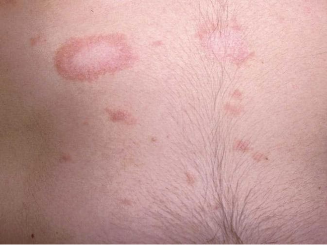 <p>acute self limiting skin disorder characterized by appearance of inflammatory oval, papulosquamous lesions</p>