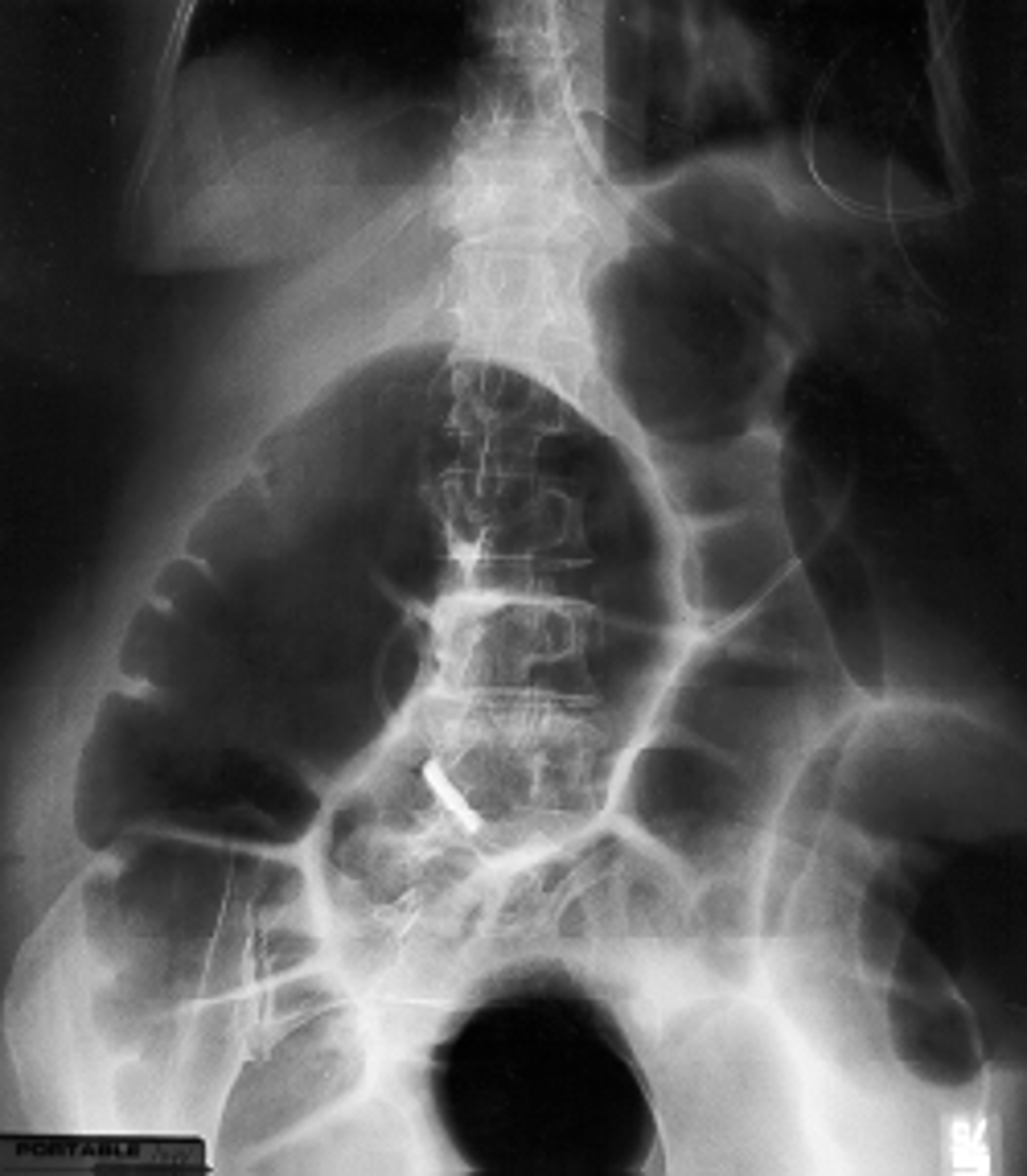 <p>Ogilvie's syndrome</p><p>(Acute colonic pseudo-obstruction)</p>