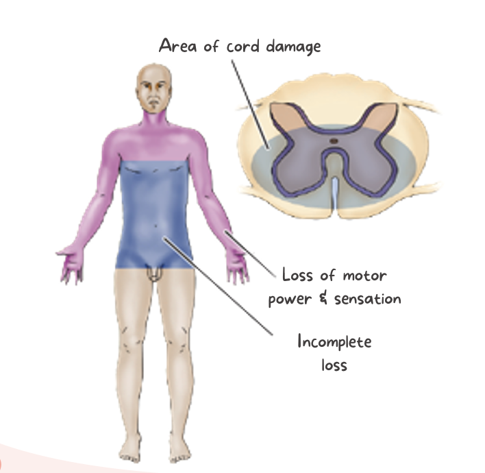 <p><strong><u>Cause</u></strong>:</p><ul><li><p>Injury or edema of central cord, typically cervical area.</p></li></ul><p><strong><u>Characteristics</u></strong>: (varies)</p><ul><li><p>Motor deficits (upper vs. lower extremities)</p></li><li><p>Sensory loss (usually more pronounced in upper extremities)</p></li><li><p>Bowel/bladder dysfunction</p></li></ul><p>*typically the most common resulting from hyper-extension of the neck; prognosis favorable but not for hand  function</p>