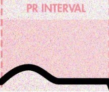 <p>SA node fires </p>