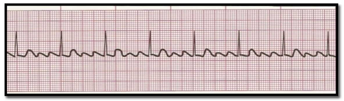 <p>What is the rhythm?</p>