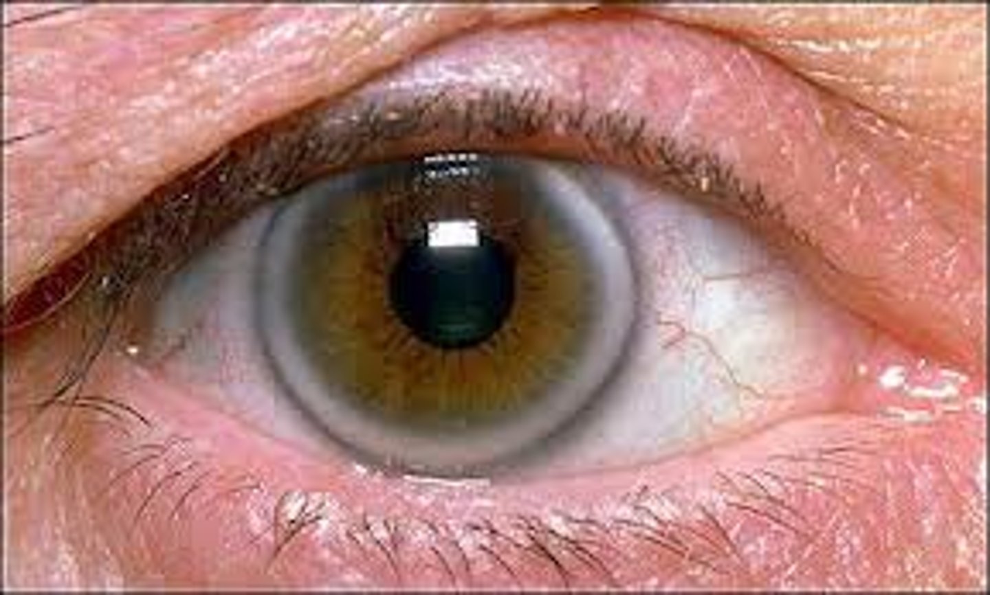 <p>Arcus senilis / Circus senilis; composed of lipid deposited in the periphery of the cornea</p>