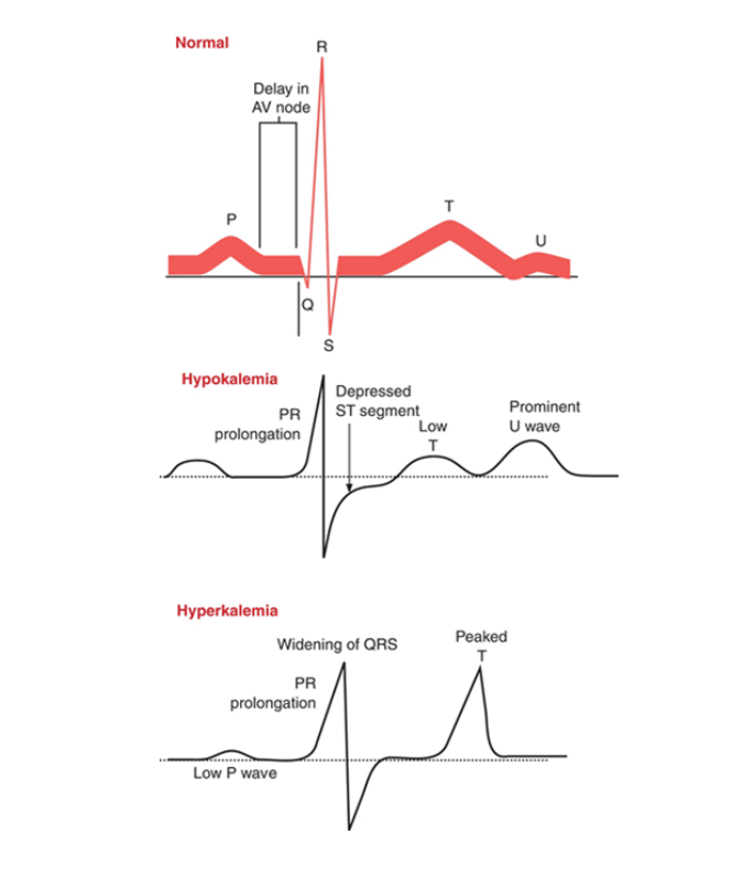 <p>Hyperkalemia: Peak T Wave; Widened QRS range</p><p>Hypokalemia: Depressed ST segment; Low T wave; Peak U wave</p><p></p>