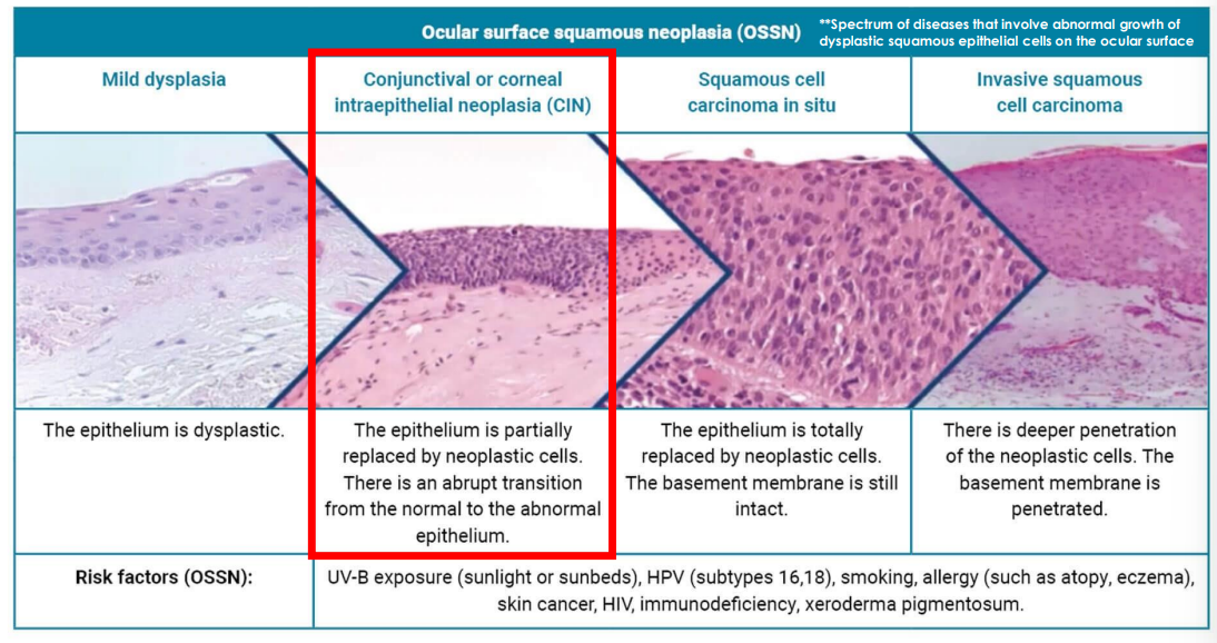 <p>OSSN</p><p>ocular surface corneal intraepithelial neoplasia</p>