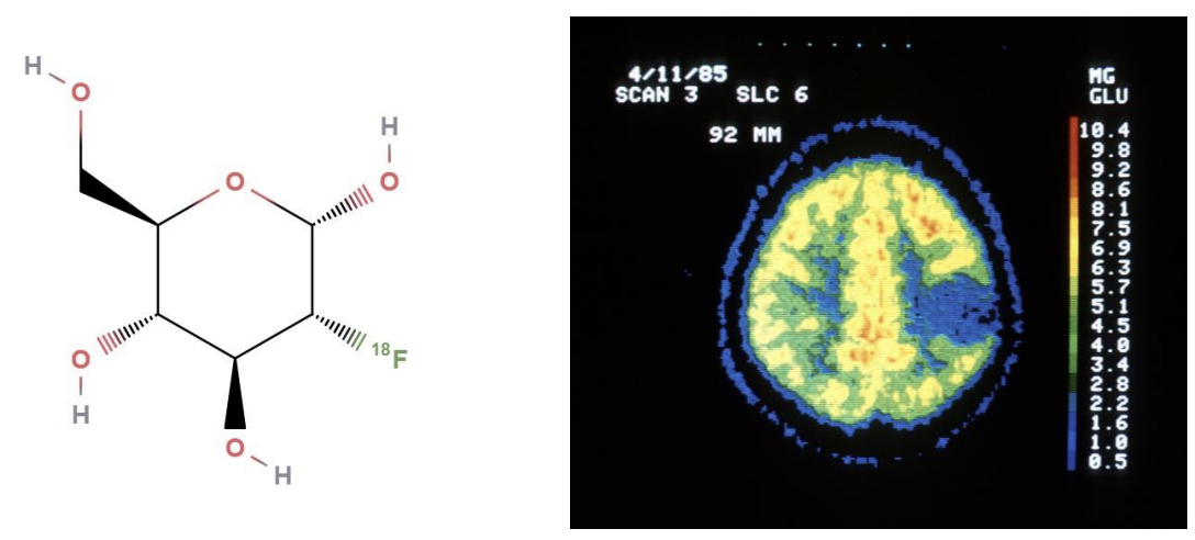 3D<br />visualisation of glucose uptake using sugar analogue labelled with F18