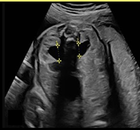 <p>what is the most common abn of the fetal urinary system</p><p>a) posterior urethral valves</p><p>b) polycystic kidney disease</p><p>c) multicystic kidney disease</p><p>d) hydronephrosis</p>