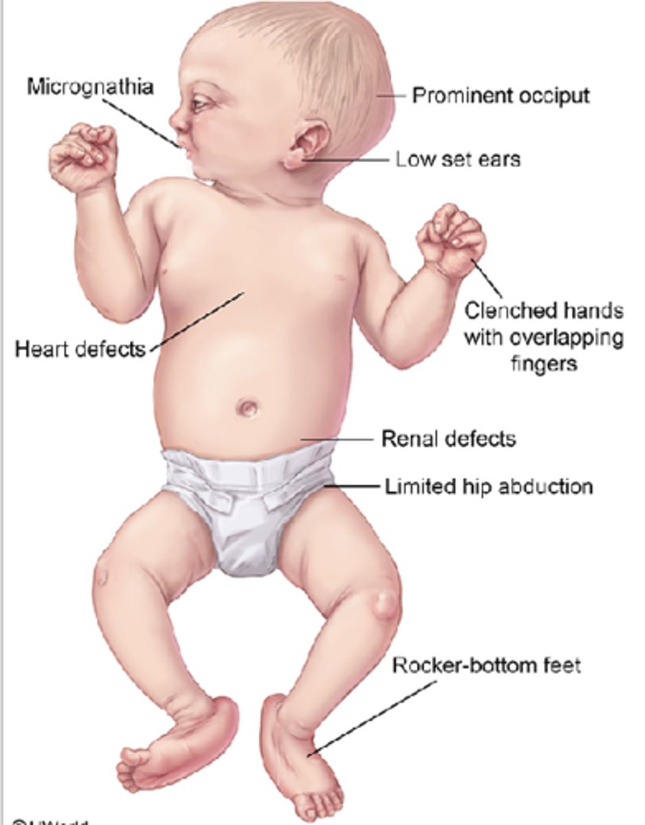 <p>Edward syndrome (trisomy 18)</p>