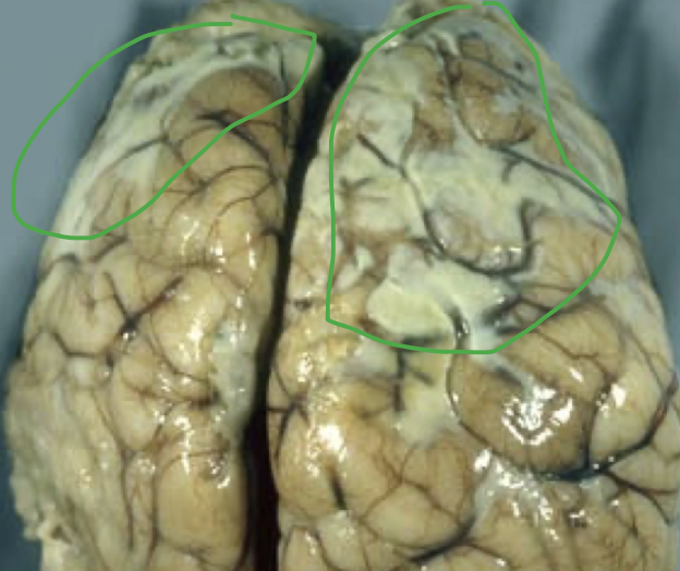 <p>result of severe inflammatory insult in which the exudate composed mainly of dead neutrophils that release lysosomal granules and cause tissue necrosis</p>