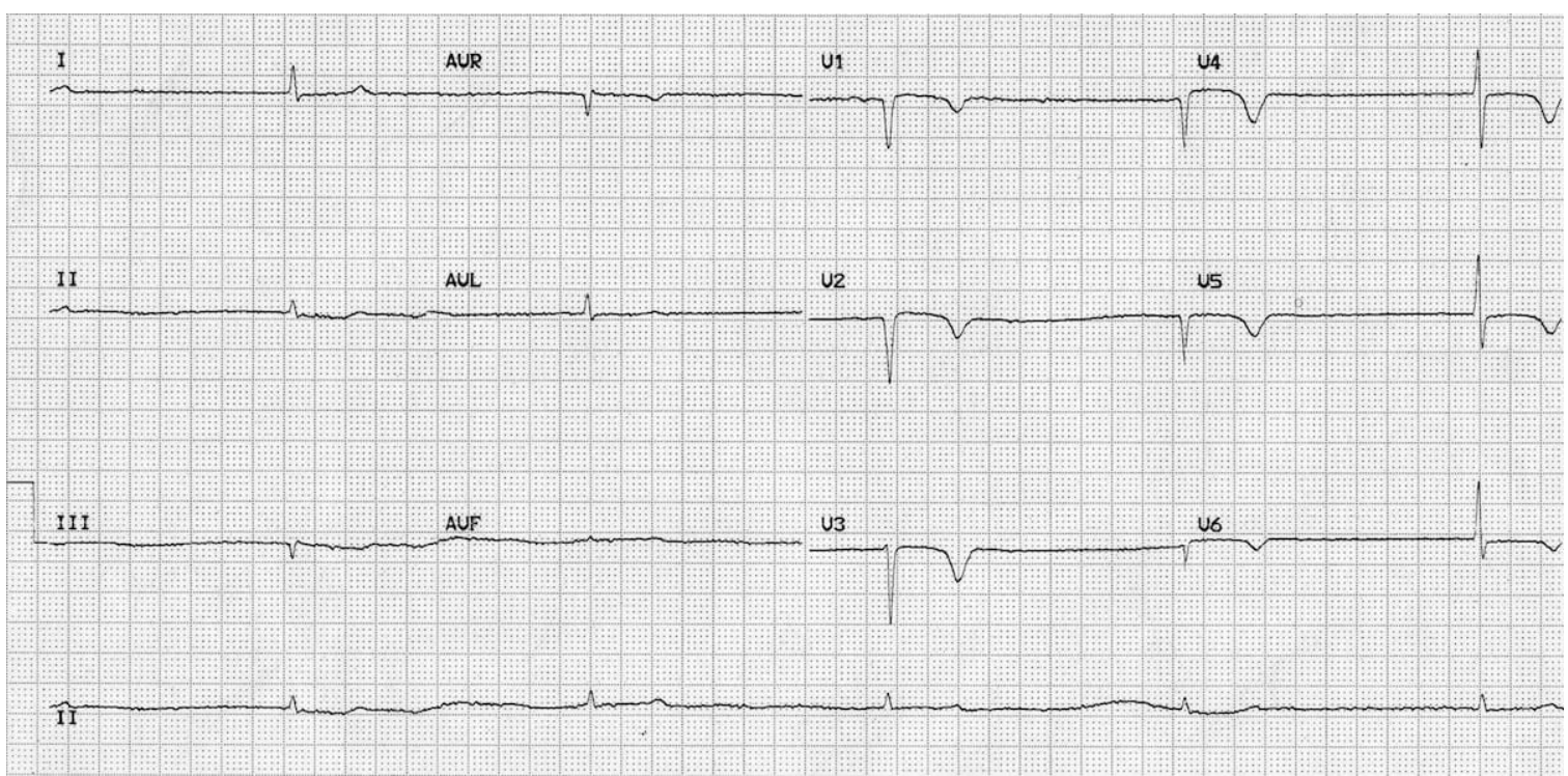 <p>67 y/o woman presents to the ER for altered mental status. PSHx is positive for complete thyroidectomy. Vitals are as follows 94.5 temperature, 30 bpm, 11 RR, and 90/50 bp. Labs show hypoglycemia, hyponatremia, high TSH, extremely low free T4/T3. Your amazing, beautiful, smart ED tech hands you this EKG. What is your treatment plan? <em>Not Tested this is just for me &lt;3</em></p>