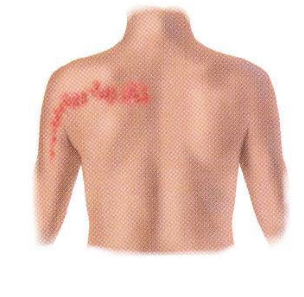 <p>what pattern of skin lesion is this? </p>