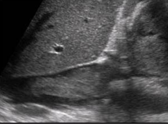 <p>The mass in the IVC on the image above is most likely consistent with which of the following diagnoses?</p><p></p><p>Rhabdomyosarcoma</p><p></p><p>Myxoma</p><p>&nbsp;</p><p>Infiltrative renal cell carcinoma</p><p>&nbsp;</p><p>Angiosarcoma</p><p>&nbsp;</p>