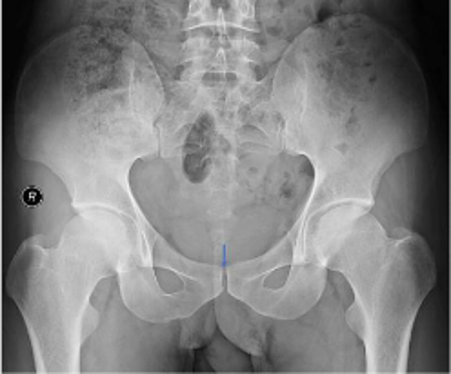 <p>What joint space is the arrow pointing to?</p>