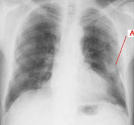 <p>Pleural Calcifications &amp; Masses</p>