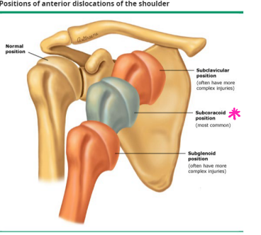<p><strong>Anterior Shoulder Dislocation: Diagnosis</strong></p><p>-_-___ (axillary and scapular Y view)</p><ul><li><p>Humeral head in ___________ (most common)</p></li><li><p>Subclavicular or ___________ position</p></li></ul><p>-Associated fractures</p><ul><li><p>____-_____'_ Deformity → cortical depression in the humeral head (groove fracture)</p></li><li><p>Bony _______ Lesion → bony vs soft tissue, disrupted glenoid labrum with or without bony avulsion</p></li><li><p>Greater tuberosity fracture </p></li></ul><p>-MRI if concerned about soft tissue injury</p>