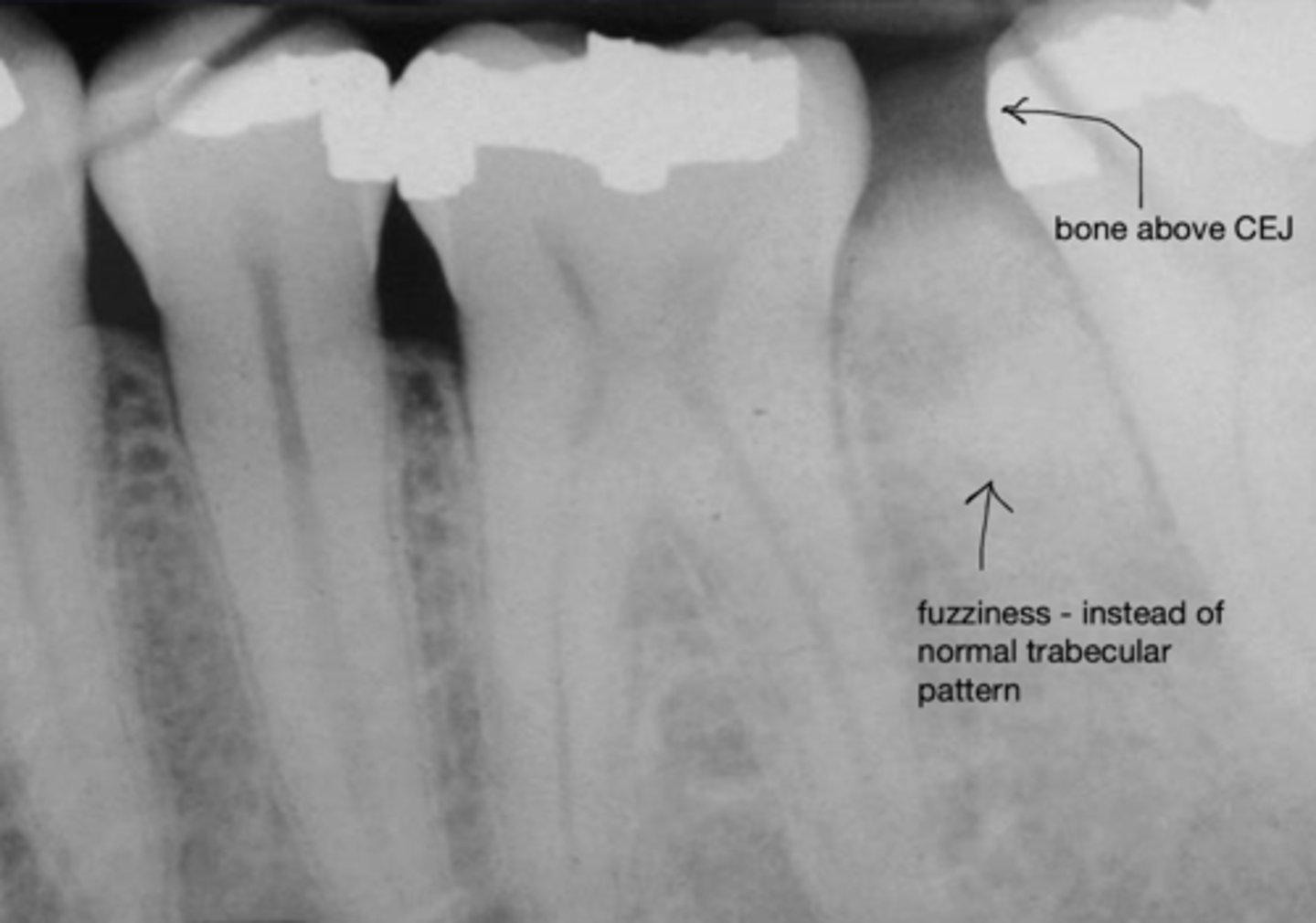 <p>- Bone above CEJ</p><p>- Fuzziness - instead of normal trabecular pattern</p>