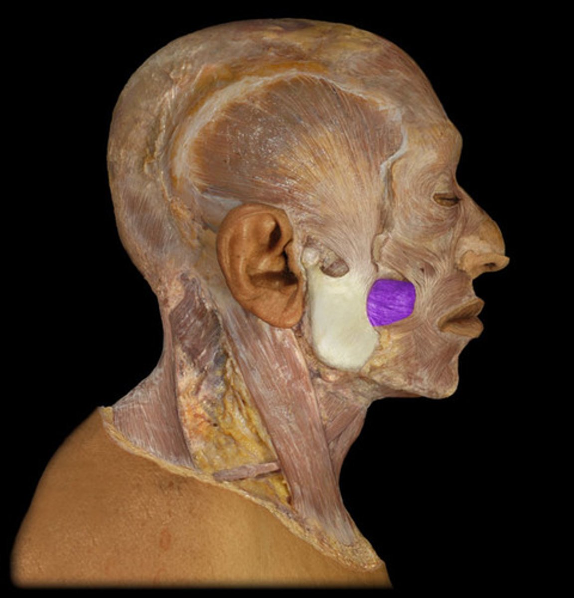 <p>Principle muscle of cheek; makes up part of the angulus oris eminences (natural facial markings); Compresses cheeks, pulls angulus oris posteriorly, produces "sucking" action, the "trumpeters" muscle; Origin = alveolar process of the maxilla; Insertion = Into muscle of the mouth</p>