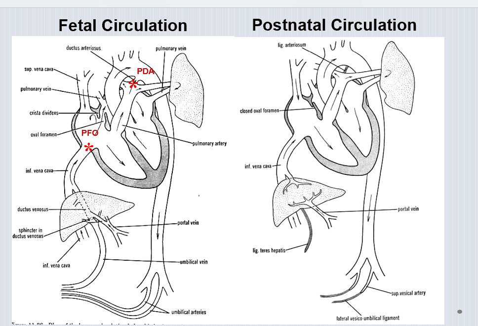 <p>Incomplete closure of oval foramen → persistent atrial shunt.</p><img src="https://knowt-user-attachments.s3.amazonaws.com/6034438a-97d9-40c1-af84-cd3d952de495.png" data-width="100%" data-align="center"><p></p>