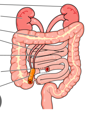 <p>anastomosis (ana stoma osmosis) of the ureters to (an isolated loop) of the ileum drained trough a stoma on the abdominal wall </p>