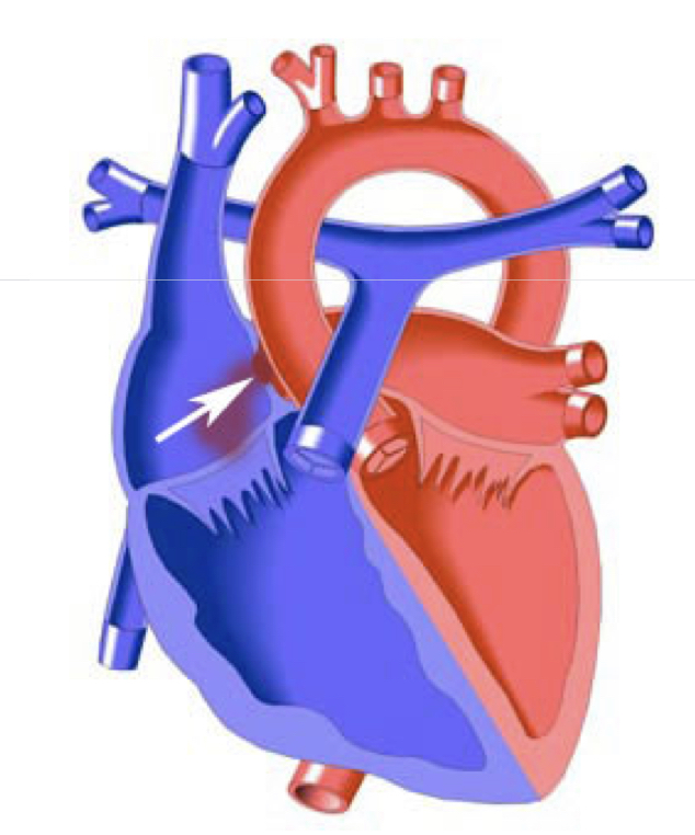 <p><strong>hole in the wall separating the atrium</strong></p><ul><li><p>creates a <strong>left to right shunt</strong></p></li><li><p><strong>results in increased workload on the right heart</strong></p></li><li><p><strong>small shunts do not require therapy!</strong></p></li></ul><p></p>