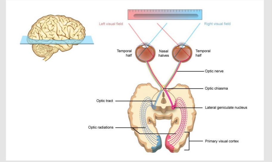 <p>The Visual Pathway</p><ul><li><p>Information collected by the retina exits the eye through the optic nerve</p></li><li><p>The optic nerve leads to the optic chiasm where the optic nerves meet</p><ul><li><p>Information from the left visual field passes to the right lateral geniculate nucleus</p></li><li><p>Information from the right visual field passes to the left lateral geniculate nucleus (LGN)</p></li></ul></li><li><p>From the LGN the information goes via the optic radiations to the primary visual cortex</p></li><li><p>The optic chiasm sorts nerves according to the information they will carry</p></li><li><p>The left visual cortex receives information from both eyes but one visual field</p></li><li><p>The right visual cortex receives information from both eyes but one visual field</p></li><li><p>This sorting of nerves helps us locate where visual field defects originate from</p></li></ul><p>Each visual cortex receives information from both eye but only ______ visual field.</p>