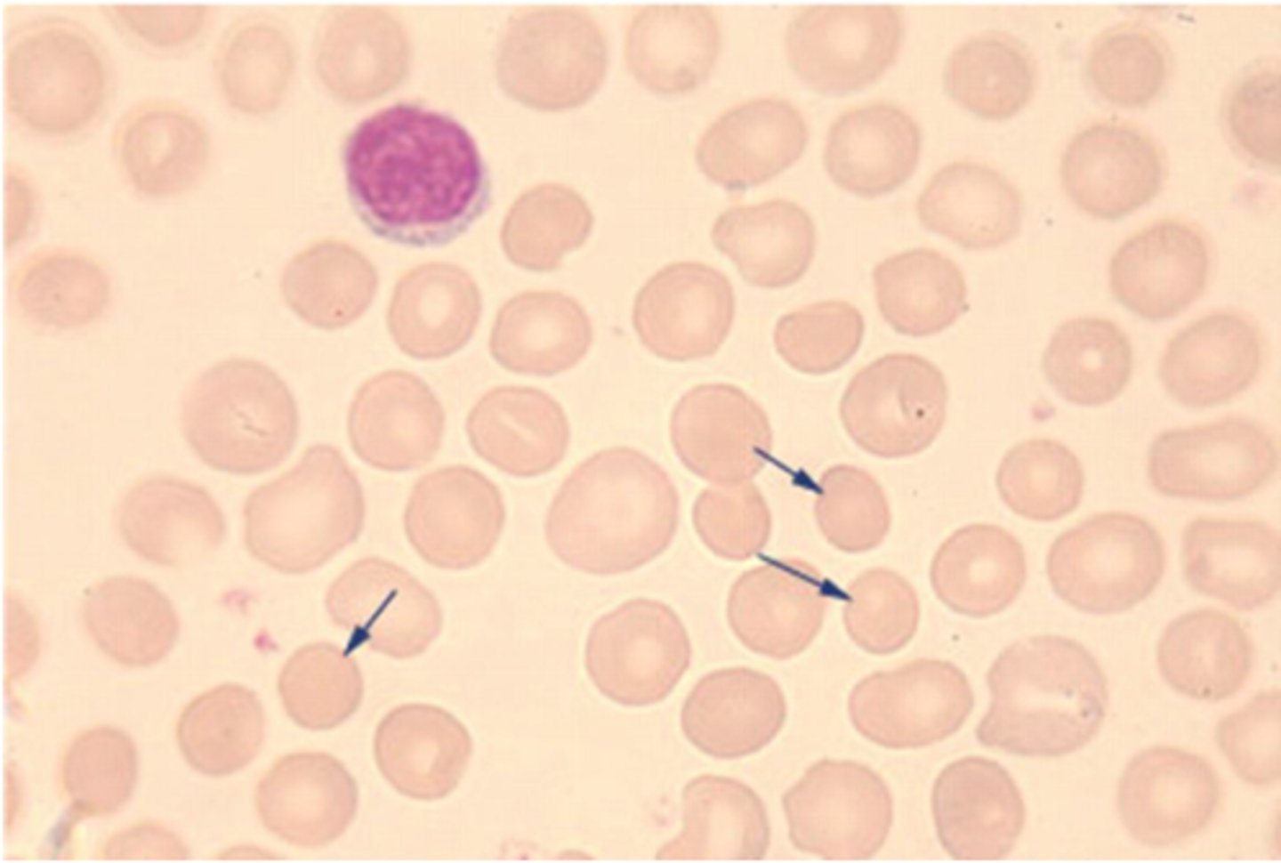 <p>cells that are spherical in shape with lost central pallor</p><p>(cell shape)</p>