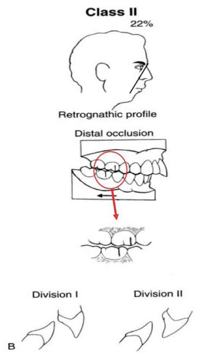 <p>Retrognathic profile (22% angle), distal occlusion, posterior- MB cusp of max 1st is situated over the embrasure btwn the mand 2nd PM and 1st molar, Anterior Div I, Anterior Div II</p>