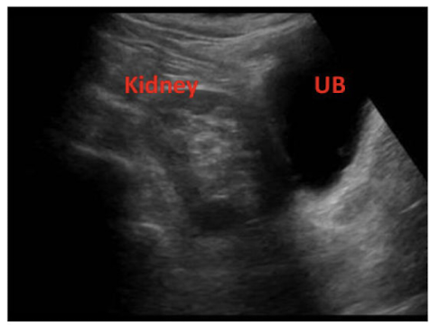 <p>check the pelvic region first&nbsp;to see if the kidney is there since this is the most common location for ectopic kidney</p>