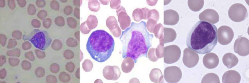 <p>A. Identify the abnormality / cell</p><p>B. This is seen in what condition / disease</p>