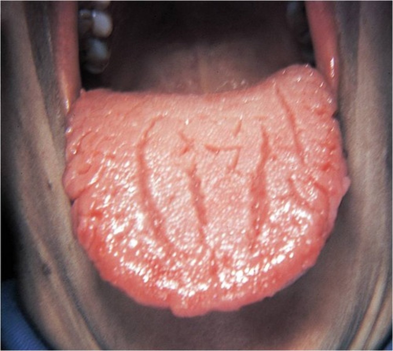 <p>Fissures and grooves on dorsal tongue surface</p><p>Common in Down Syndrome clients</p><p>Furrowed tongue</p><p>Scrotal Tongue</p>