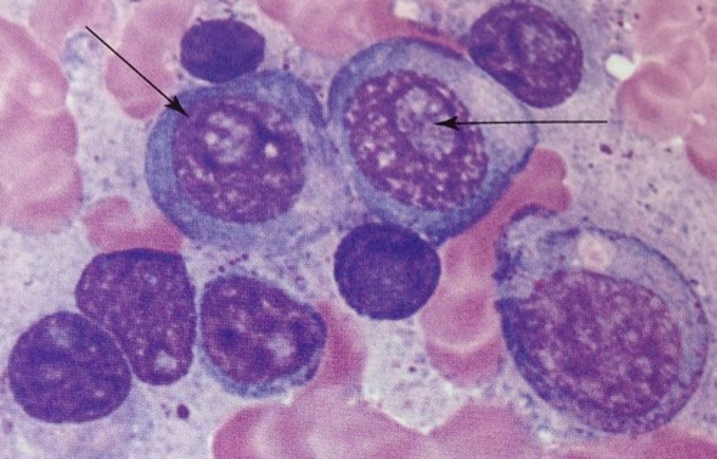 <p>an intranuclear globular inclusion that is highly specific to neoplastic myeloma cells, and there is little doubt regarding the neoplastic characteristics if observed.</p>
