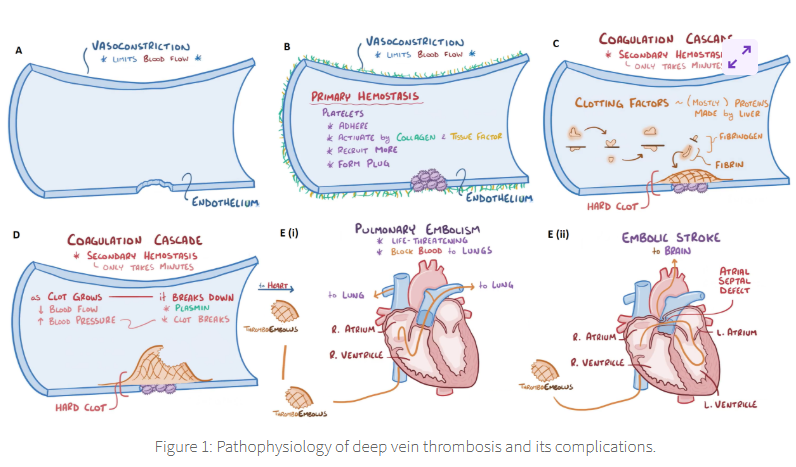 <p><span>the pathophysiology of Deep Vein Thrombosis (DVT) </span></p>