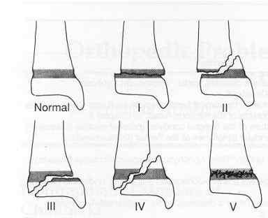 <p>fracture through growth plate</p>