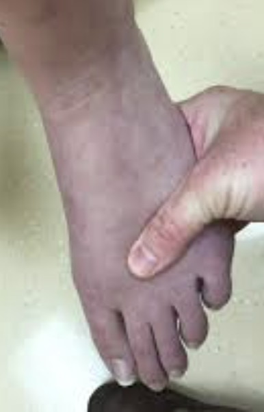 <p>Abnormal Skin Pigmentation Finding</p><ul><li><p>May cause white skin to appear <strong>blue</strong>-tinged, especially in the perioral, nail bed, and conjunctival areas</p></li><li><p>Dark skin may appear <strong>blue, dull, and lifeless</strong> in the same areas</p></li><li><p>Either <strong>central</strong> or <strong>peripheral</strong></p></li><li><p>Due to <strong>poor oxygenation</strong></p></li></ul><p></p>