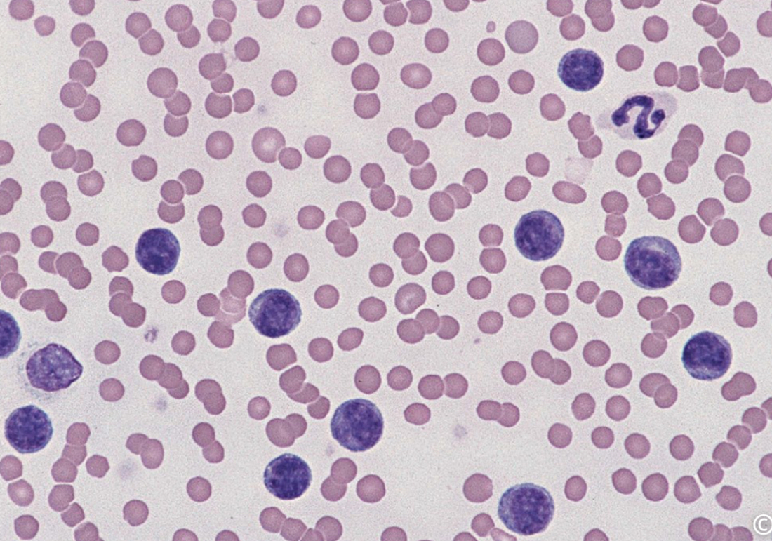 <p>Based on the predominant cell type seen in the image, would you suspect a myeloid or lymphoid neoplasm?</p>