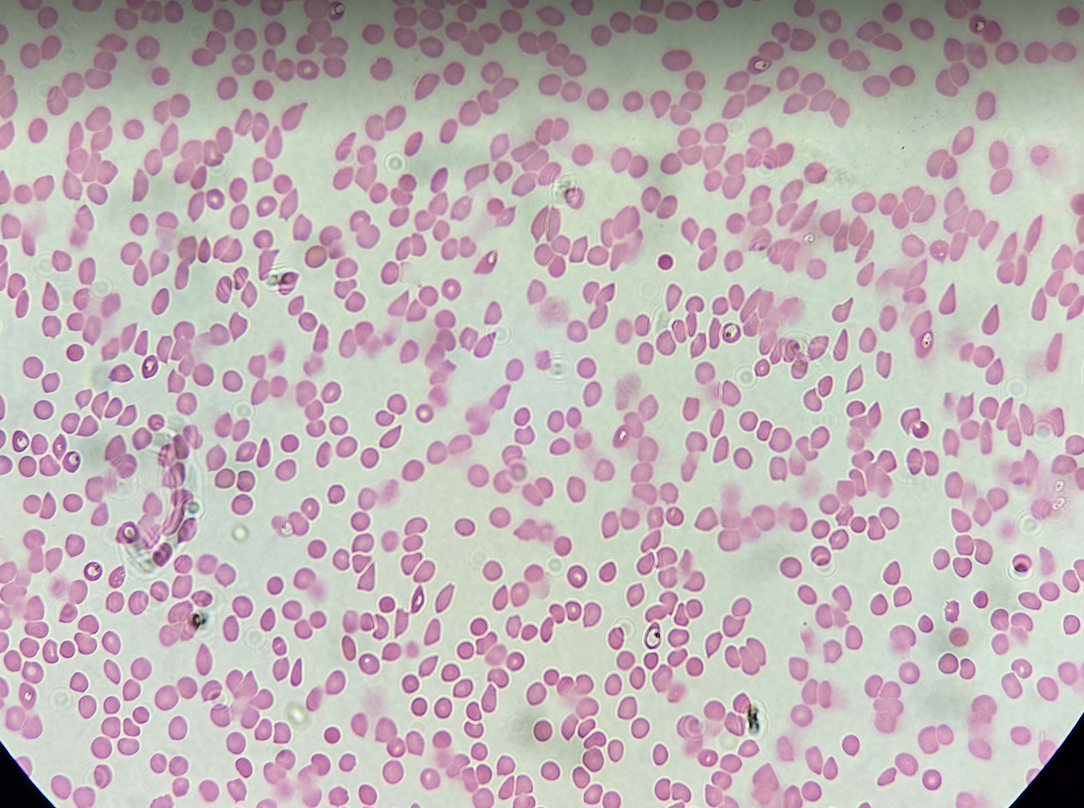 <p><span data-name="microscope" data-type="emoji">🔬</span><span data-name="petri_dish" data-type="emoji">🧫</span><strong><span> </span>Na podstawie zdjęcia preparatu:</strong></p><p></p><ul><li><p><span data-name="book" data-type="emoji">📖</span><span> </span>rozpoznaj gatunek pasożyta;</p></li></ul><p></p><ul><li><p><span data-name="recycle" data-type="emoji">♻</span><span> </span>rozpoznaj wszystkie formy rozwojowe;</p></li></ul><p></p><ul><li><p><span data-name="microbe" data-type="emoji">🦠</span><span> </span>wskaż organelle i cechy charakterystyczne dla danego gatunku;</p></li></ul><p></p><ul><li><p><span data-name="mask" data-type="emoji">😷</span><span> </span>nazwij chorobę, którą pasożyt wywołuje.</p></li></ul><p></p>