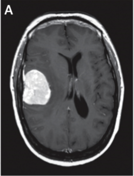<p>Map based on tissue density and X-ray absorption, best for strokes and tumors</p>