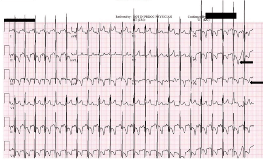 <p>BVH diagnosis:</p>