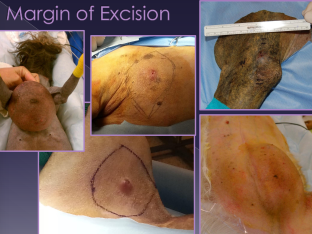 <ul><li><p><strong>1 and done</strong></p><ul><li><p>Excise all neoplastic tissue</p></li></ul></li><li><p><strong>Aggressiveness (surgical ‘dose’) - common to leave some</strong></p><ul><li><p>› Intralesional (debulking) - leave some behind (airway)</p><p>› Marginal - edge, peripheral to pseudocapsule, <span style="color: red;">Lipoma, common w/o biopsy</span></p><p>› Wide - clean margins</p><ul><li><p><span style="color: red;">Solid masses, 1-2 facial planes deep, margin of normal tissue excised</span></p><p>› Radical - amputation, entire tissue</p><ul><li><p>splenectomy, mammary chain</p></li></ul></li></ul></li></ul></li><li><p><span style="color: red;">better to leave a wound open … than tumor cells remaining</span></p></li><li><p>Resection:  <strong>“dirty</strong>” margins</p><ul><li><p>Have to go <strong>Deep and lateral</strong></p></li></ul></li></ul><p></p>