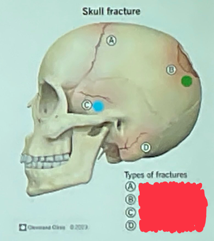 <p>What type of skull fracture is letter B?</p>
