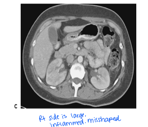 <p>pyelonephritis is a severe urinary tract obstruction when there is suspicion of abscess, obstruction, or complications. </p><p>An infection that can be difficult to dx on CT if patient is not responsive to treatment</p>
