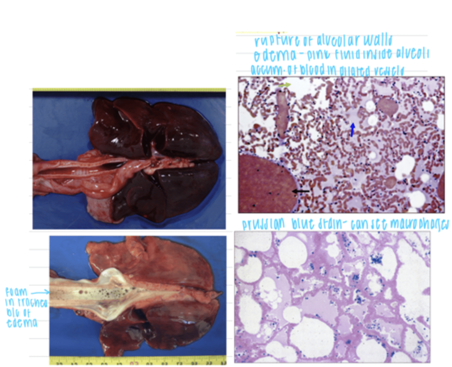 <p>grossly:</p><p>enlarged </p><p>dark</p><p>foam in the trachea</p><p>microscopically:</p><p>dilated, blood filled capillaries</p><p>macrophages with hemosiderin</p><p>pulmonary edema</p><p>septal fibrosis</p>