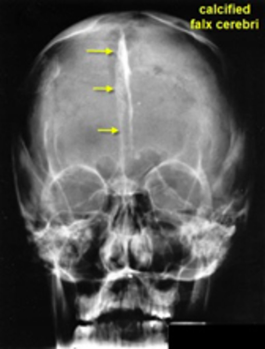<p>Calcification of falx cerebri is associated with what type of cyst?</p>