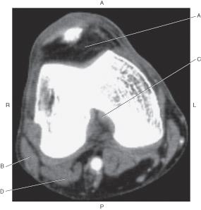 <p>Which line points to the biceps femoris muscle?*</p>
