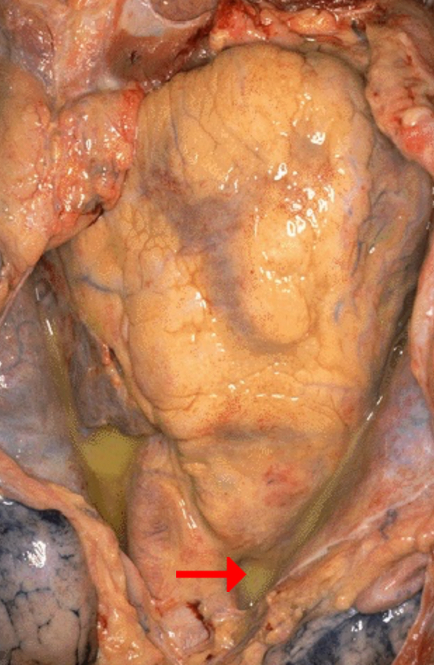 <ol><li><p>Identify morphologic pattern of acute inflammation</p></li><li><p>What could be the underlying cause of the disease leading to accumulation of the pointed yellowish fluid?</p></li></ol><p></p>