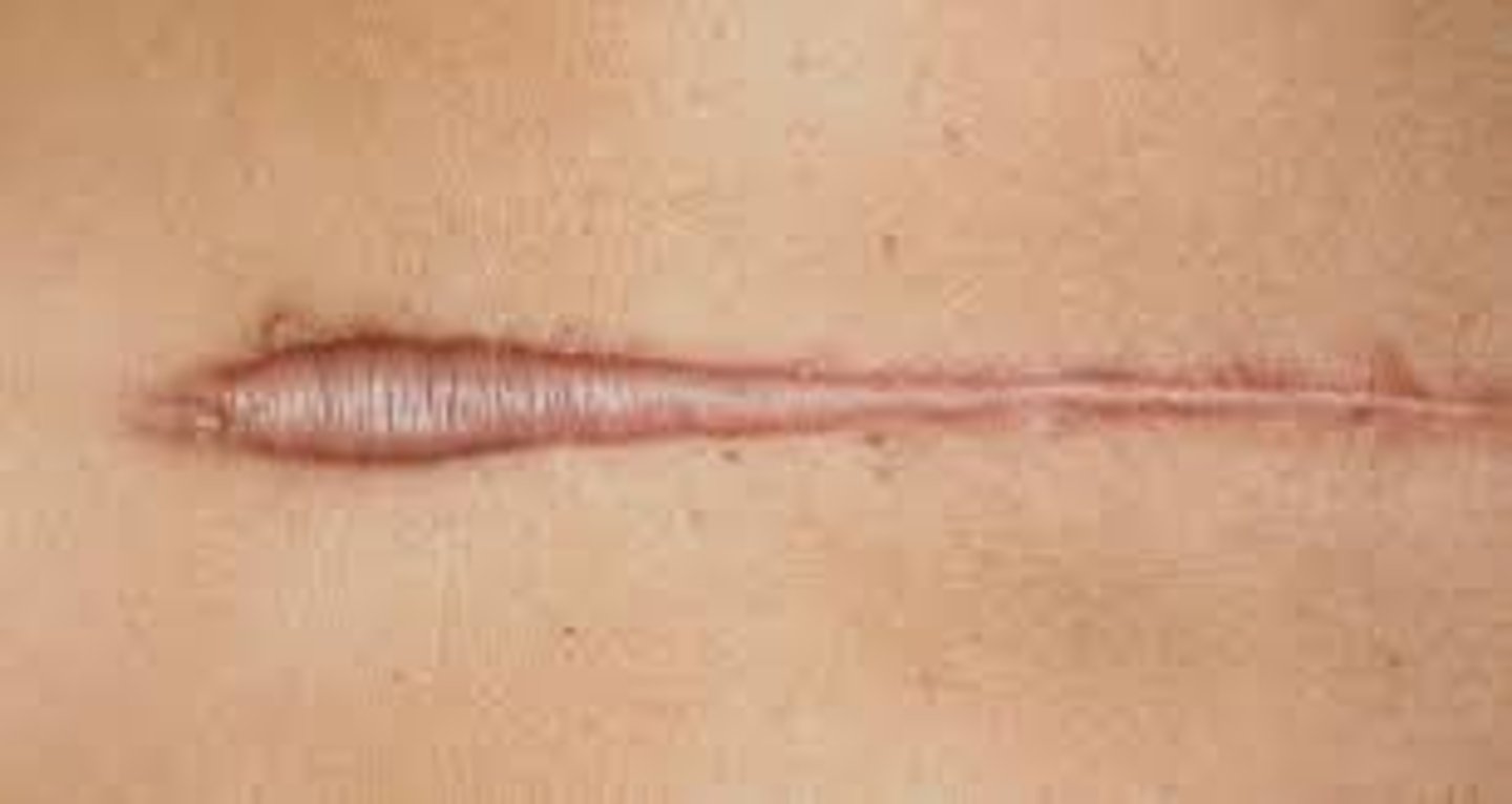 <p>-Overgrowth of tissue on a wound</p><p>-Progressively enlarging scar</p><p>-Laser can remove this, but it often returns</p><p>Examples:</p><p>-Earrings (piercing)</p><p>-Lacerations</p><p>Note: common in African Americans</p>